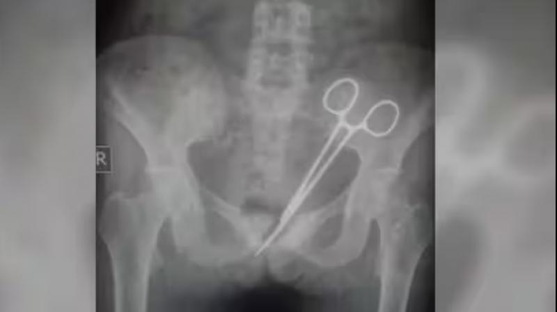 Scissors lying in the woman's stomach for 12 years