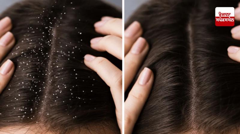 Follow these home remedies to get rid of dandruff in winter