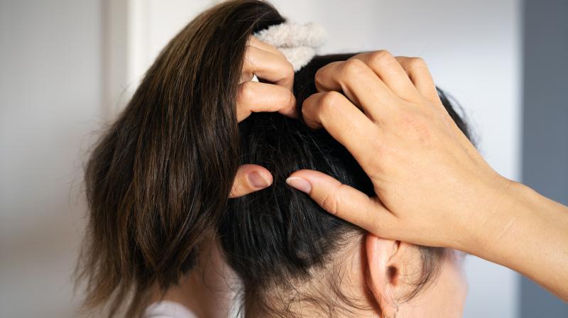 Home remedies to treat itchy scalp