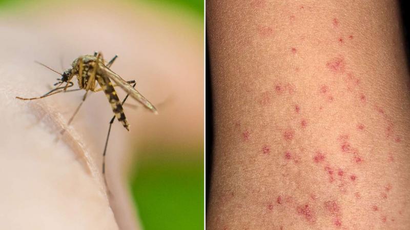 Health News: Risk of dengue