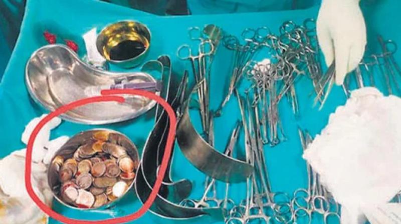 Bagalkot: Doctors remove 187 coins from man’s stomach