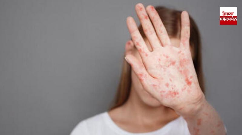 America Measles Disease News