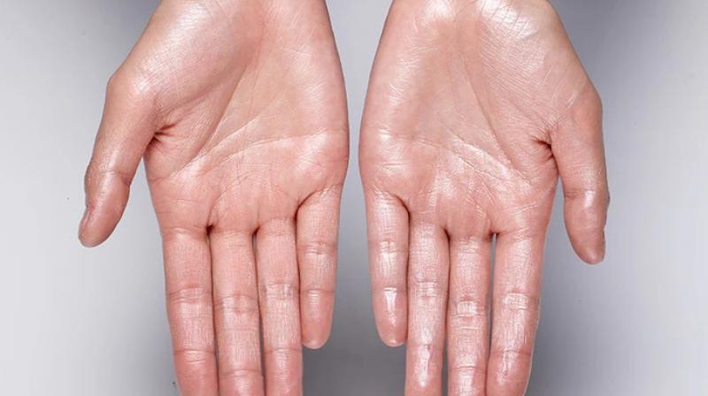 If you are suffering from sweating of hands and feet then treat it like this