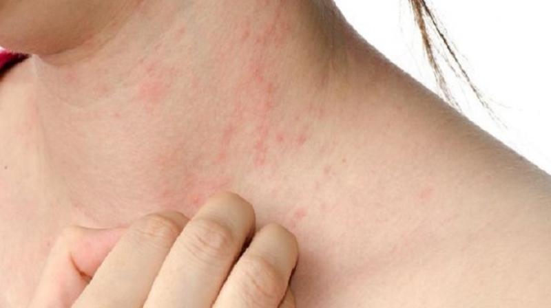 Try these recipes to get rid of bile problem in summer