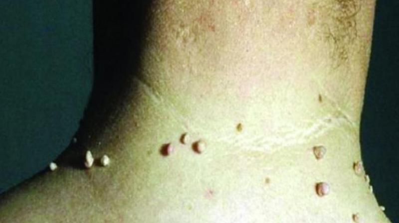 People suffering from the problem of moles can get relief with these home remedies Health News