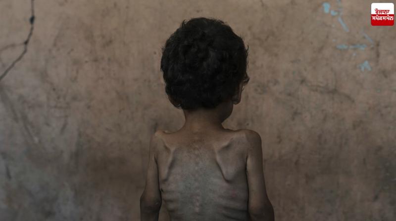 55,000 young children in Gaza suffer from severe malnutrition UN News