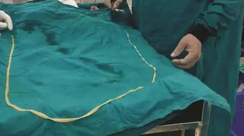 Kaithal alive insect of 6.3 feet long removed from the patients intestine