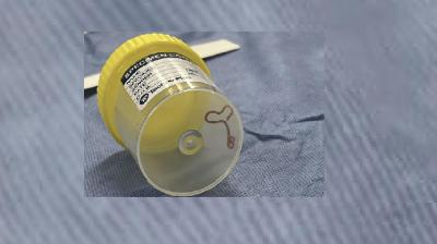 Parasite in a specimen jar.