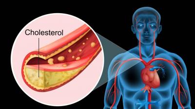 ਕੋਲੈਸਟਰੋਲ ਵਿਰੋਧੀ ਦਵਾਈਆਂ ਸ਼ੂਗਰ ਦੇ ਮਰੀਜ਼ਾਂ ਵਿਚ ਮੌਤ ਦੇ ਜੋਖਮ ਨੂੰ ਘਟਾ ਸਕਦੀਆਂ ਹਨ : ਨਵੀਂ ਖੋਜ