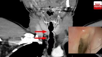 Smoke cigarettes every day, black hair started growing on his neck Health News