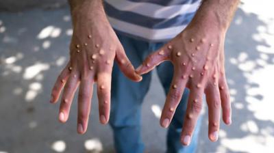 Ampox virus reached Pakistan