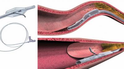 inexpensive technique