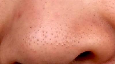 Get rid of Blackheads