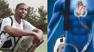 A person lived for 555 days without 'heart'