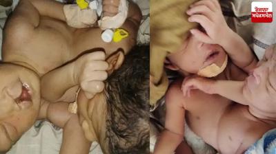 Haryana twin girls born in ambala separate bodies one heart