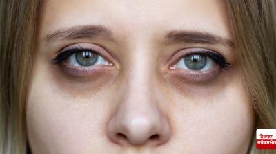 Get rid of dark circles under your eyes in a week Beauty Tips