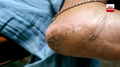 If your heels are cracked in winter then follow this recipe