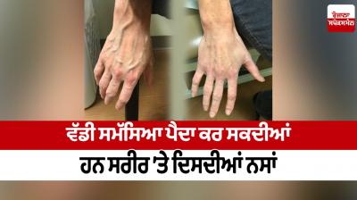 Nerves visible on body can cause a big problem