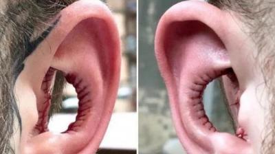 He got his earlobes removed to hear more