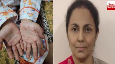 Mohali Civil Surgeon statement on suspected case of Monkeypox