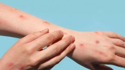 Know how monkeypox virus spreads, symptoms and treatment
