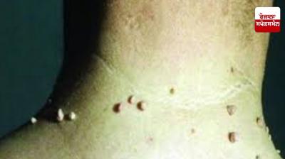 People suffering from the problem of moles can get relief with these home remedies