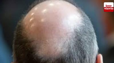 Case registered against 2 people in connection with camp held to cure baldness
