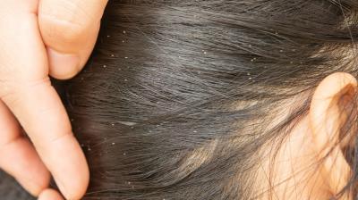 Head lice