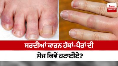 How to remove swelling of hands and feet due to winter?