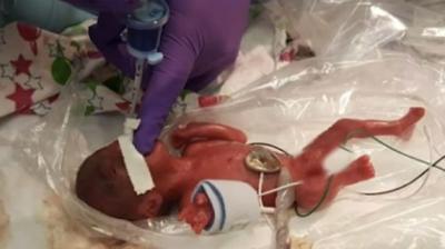 smallest surviving infant