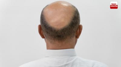  Hair Fall Health News