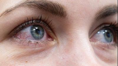 Pink eyes may be the primary symptom of covid-19: a study