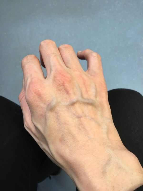 Visible veins on the body can cause major problems