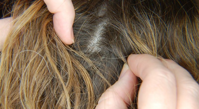 Head lice