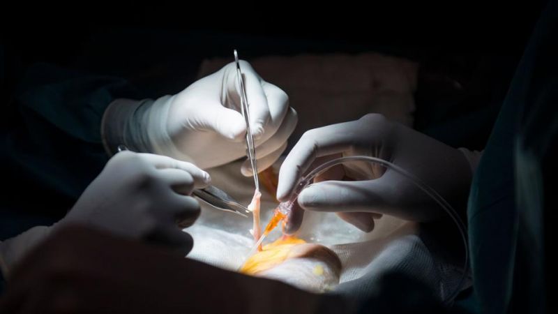 Doctors removed the kidney woman while the operation of the stone