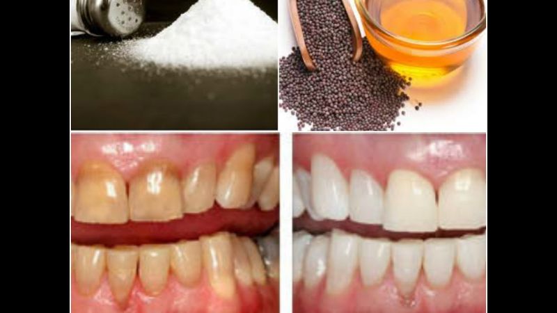 Mustard oil For Theeth