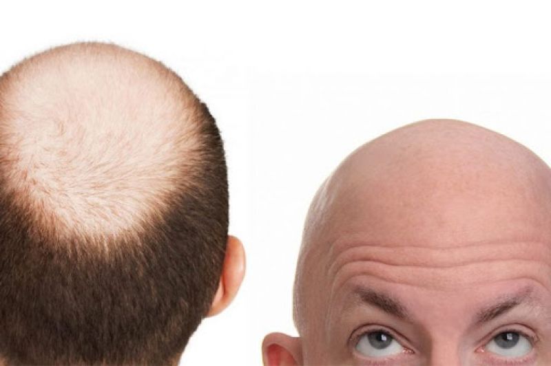 Baldness