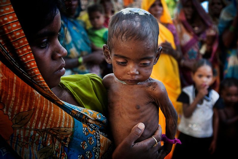 Vitamin D can improve the Malnutrition