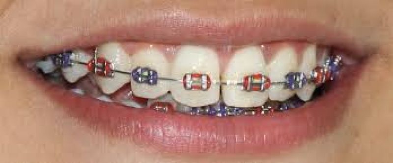 braces
