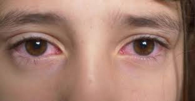 Pink eyes may be the primary symptom of covid-19: a study