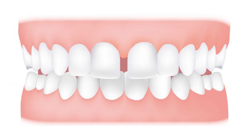Diastema