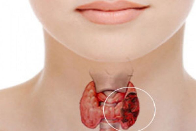 thyroid disease