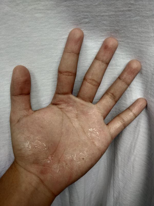 sweating in hands