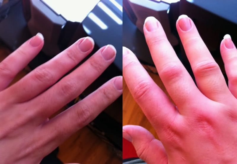 Hand swelling