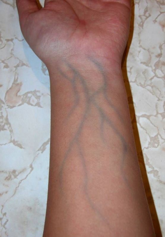 Visible veins on the body can cause major problems