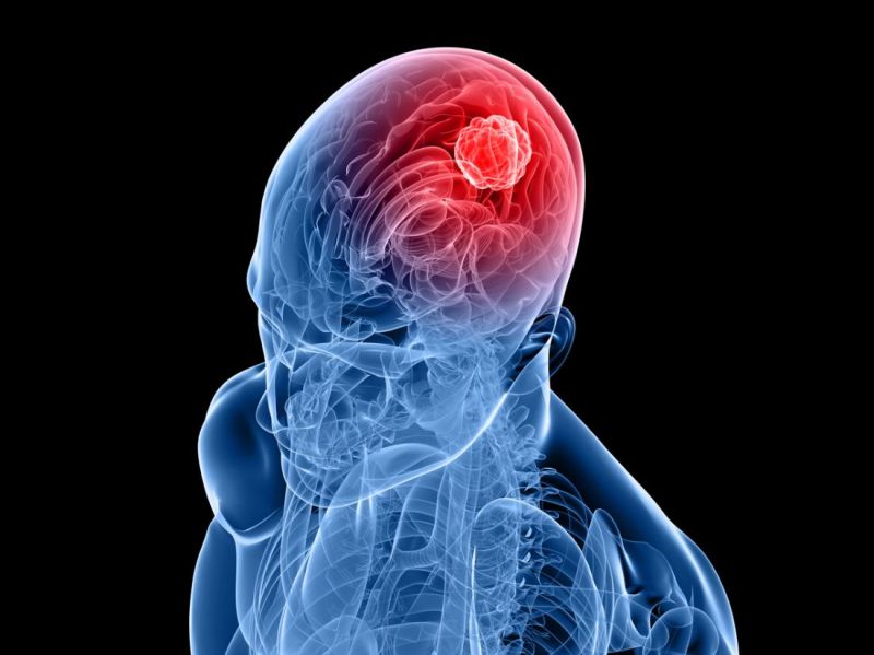 brain tumors