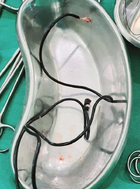 Mobile phone charger removed from bladder