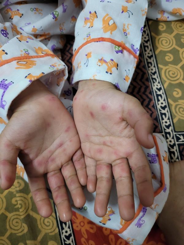 Mohali Civil Surgeon statement on suspected case of Monkeypox