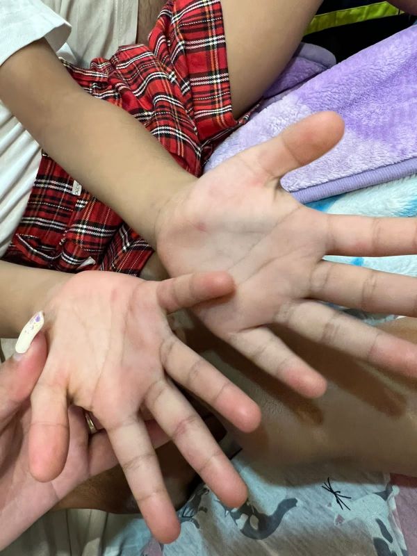 Mohali Civil Surgeon statement on suspected case of Monkeypox