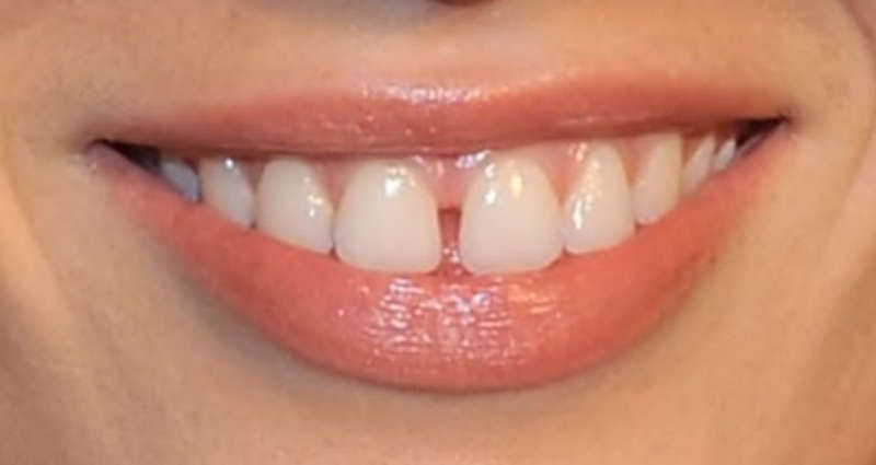 Diastema